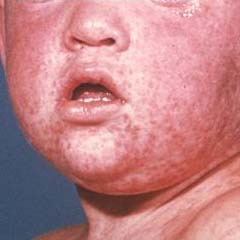 child with measles on chin