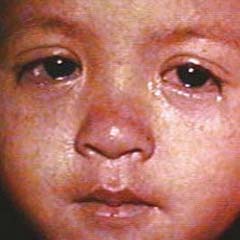 child with measles in eyes